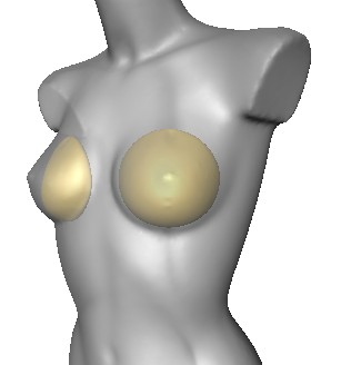 Beispiel einer 3D-Simulation zur Planung einer Brustvergrößerung