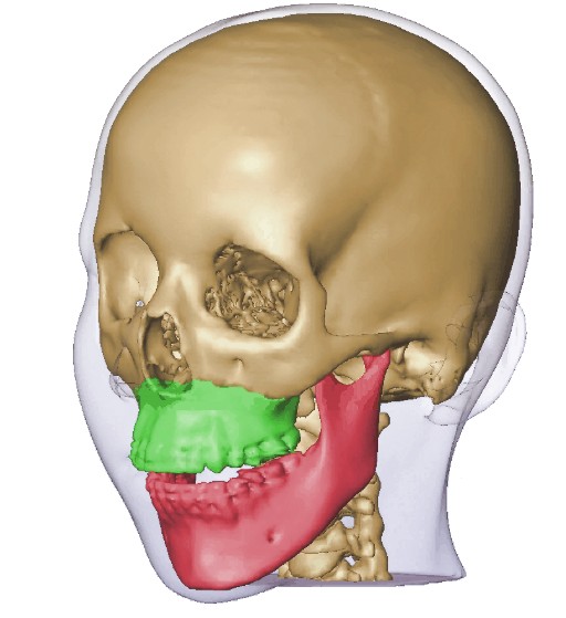 Beispiel einer 3D-Planung in der Mund-Kiefer-Gesichtschirurgie
