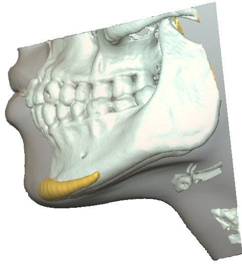 3D-Visualisierung für das Design individueller Implantate